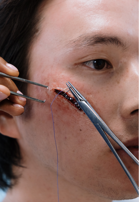 Suturing Wounds at Home: When to DIY and When to Seek Professional Help