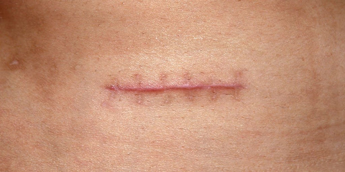 The Art of Suturing and Scar Management: Healing with Precision and Care