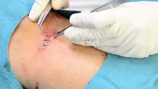 Learn How to Suture a Wound